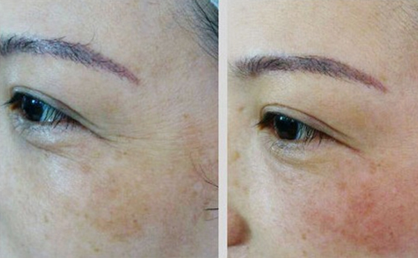 魚尾紋除皺哪些方法好？