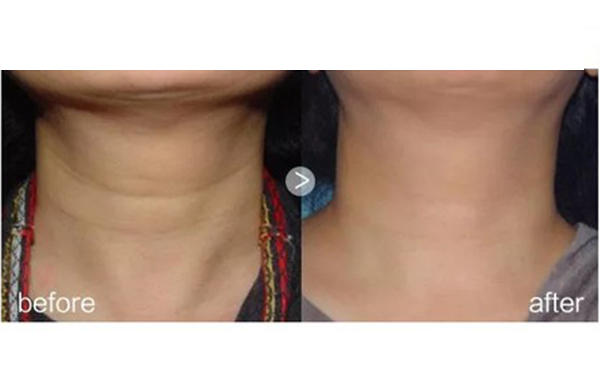 哪些人不能做嗨體？