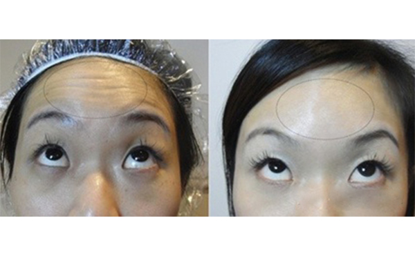 玻尿酸能去抬頭紋嗎？