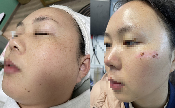 彩光嫩膚有沒有副作用？