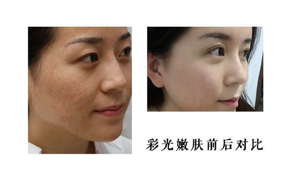 皮膚薄能做彩光嫩膚嗎？