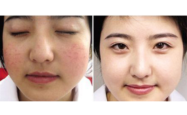 哪些人不適合做激光美白