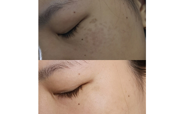 激光美白能維持多久？