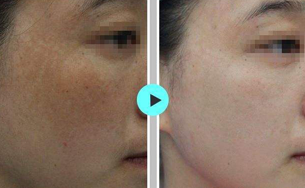 激光祛斑會(huì)使皮膚變薄嗎？