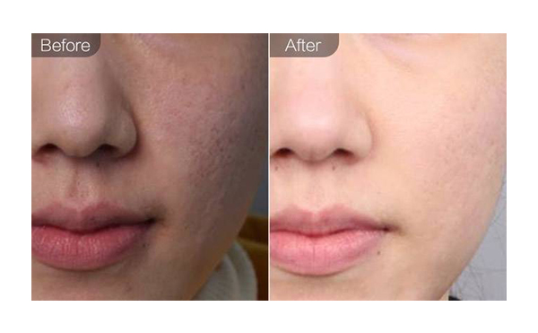 e光嫩膚適合哪些人？