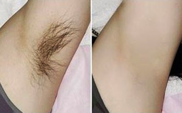 光子脫腋毛有什么優(yōu)勢?