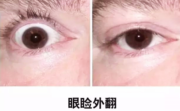 醫(yī)美技術(shù)越來越發(fā)達(dá)，不少愛美的人本著變美的心情滿懷期待地去做雙眼皮、開眼角等項(xiàng)目，不料整容不成、反倒毀容，后悔也來不及。有些做雙眼皮的姑娘術(shù)后出現(xiàn)眼瞼外翻的情況，那眼瞼外翻是什么意思?上眼瞼外翻如何修復(fù)?
