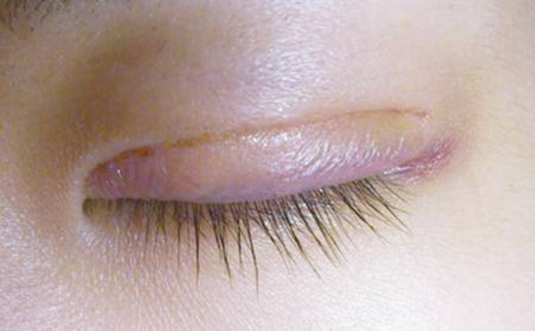 雙眼皮術(shù)后如何保養(yǎng)?手術(shù)后雙眼皮的康復(fù)階段?