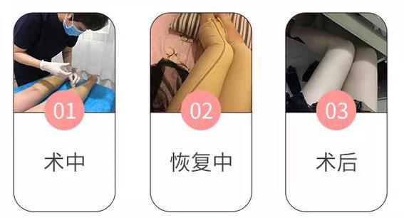 北京華韓：吸脂塑形術前術后效果對比圖