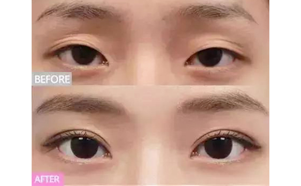 上眼皮凹陷怎么恢復(fù)飽滿?能維持多久?