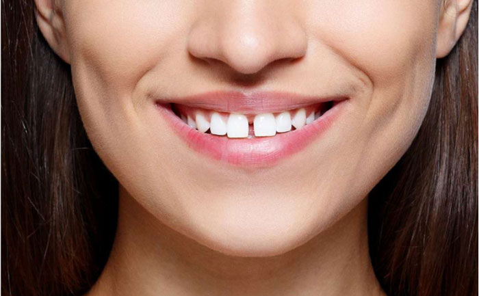 牙縫大可以矯正嗎？