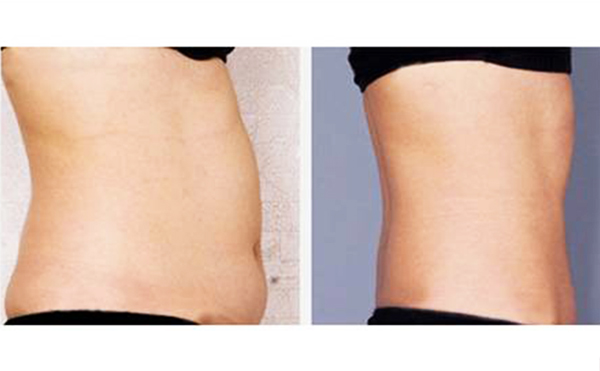 腰腹吸脂安全性高嗎？