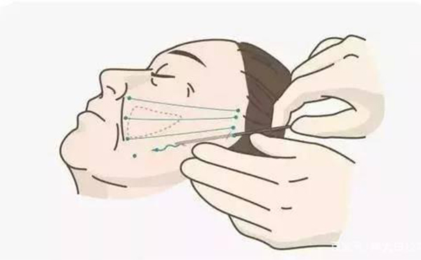 線雕提升好嗎？