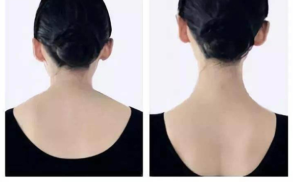 瘦肩針是用什么打的？