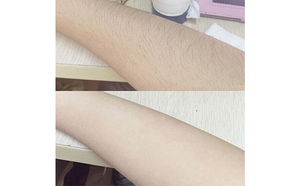 光子手臂脫毛效果怎么樣？