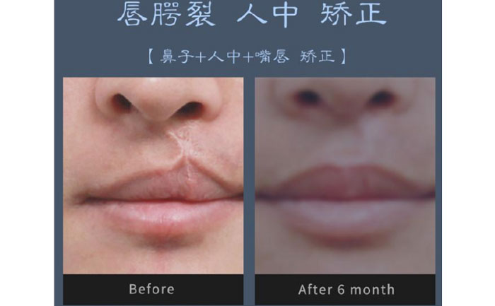唇裂修復(fù)術(shù)需要多少錢？