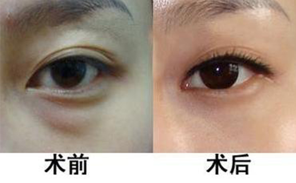 眼袋抽脂適合哪些人？