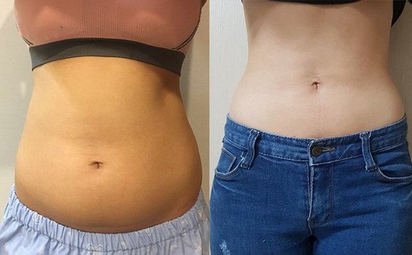 腰腹吸脂的效果好嗎？