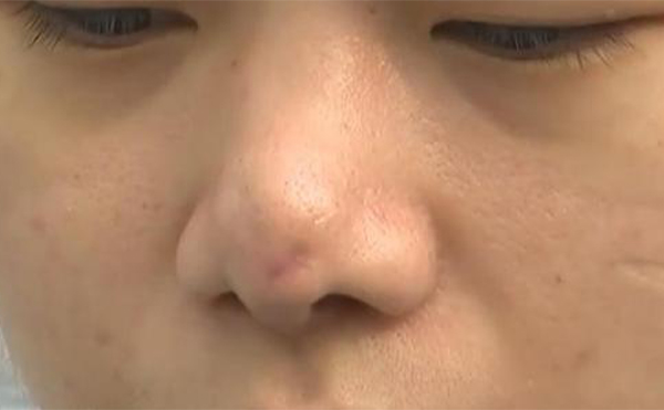 如果更換隆鼻假體，當(dāng)天可以直接換嗎?