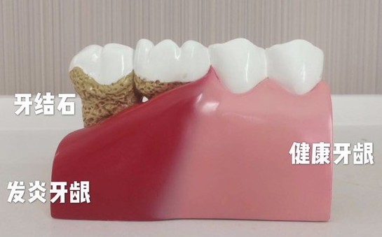 洗完牙后牙齒會變得敏感？