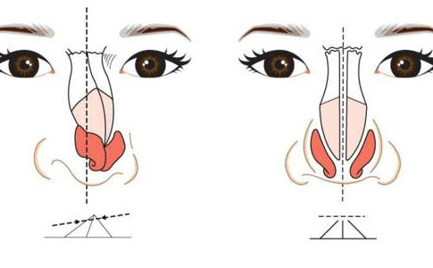 歪鼻矯正手術(shù)大概多少錢？歪鼻矯正手術(shù)成功率為多少？