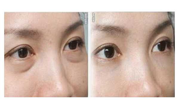 吸脂去眼袋有什么優(yōu)勢？