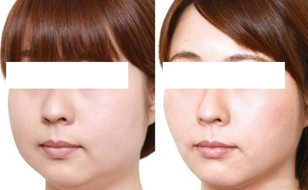 面部吸脂安全嗎？