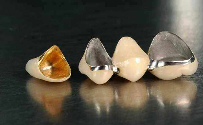 貴金屬烤瓷牙多少錢一顆？