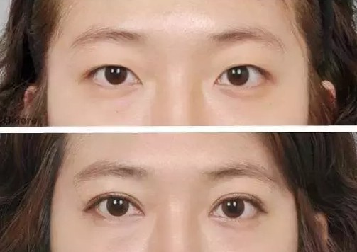 兩眼睛距離過(guò)寬