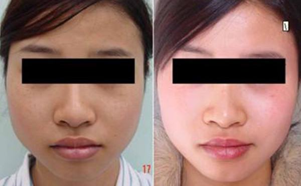 激光美白是什么原理？