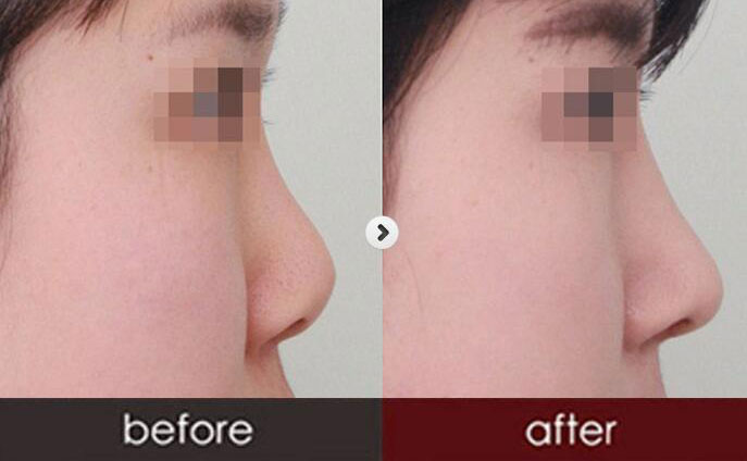 硅膠隆鼻一般需要多少錢呢？