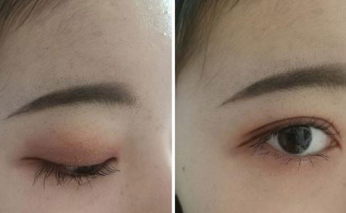 割雙眼皮的危害是什么？