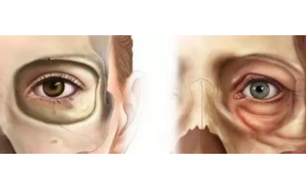 去眼袋后下眼瞼為什么凹陷?去眼袋后下眼瞼凹陷怎么辦?