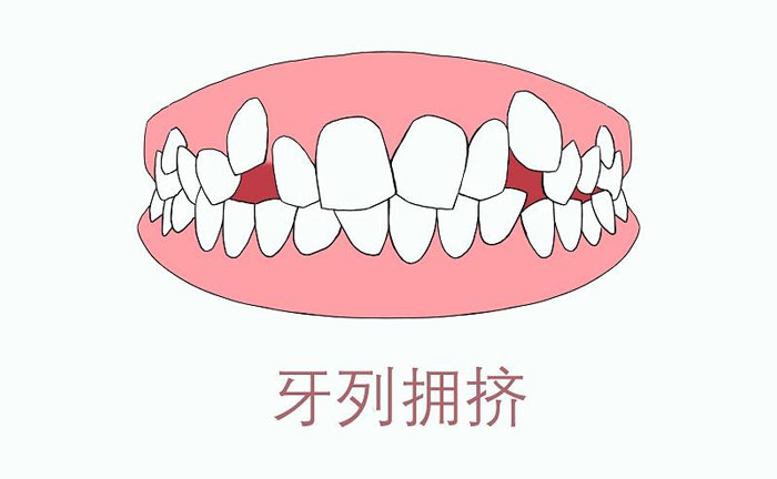 矯正牙齒擁擠度怎么算？