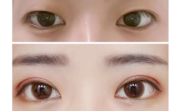 腫眼泡矯正效果是永久的嗎?哪些情況不能做腫眼泡矯正?