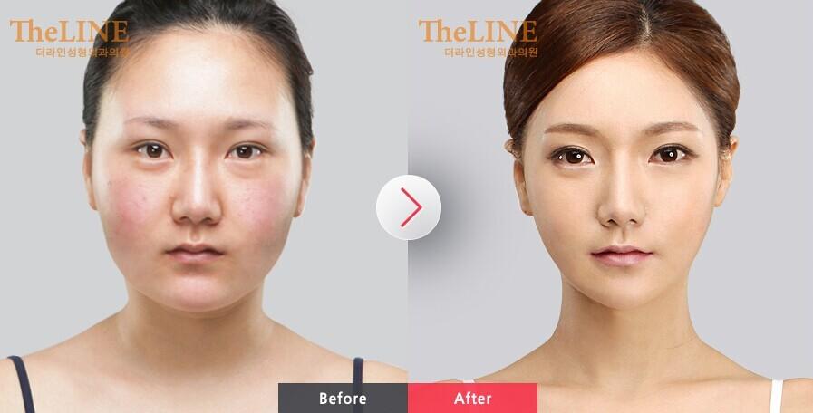 削臉頰骨需要多少錢？削臉頰骨成功率高嗎？