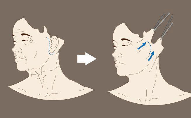 電波拉皮一次大概多少錢？