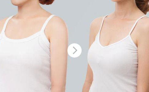 假體隆胸的費(fèi)用是多少？