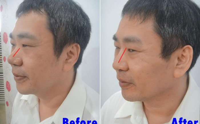 男性隆鼻子大概多少錢？