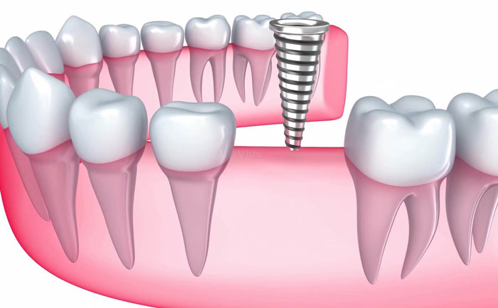 牙齒種植大概費用是多少？牙齒種植多少錢一顆