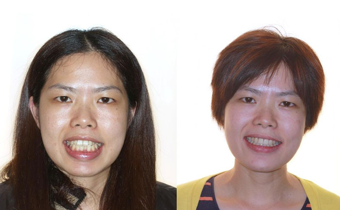 齙牙矯正可以改善凸嘴嗎？