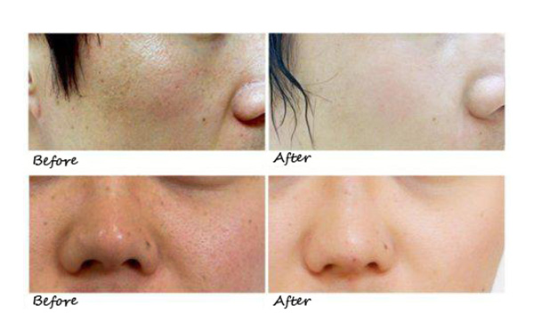 水光針的效果怎么樣？