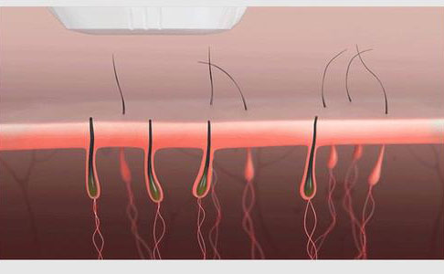 全身脫毛永久的大概需要多少錢？