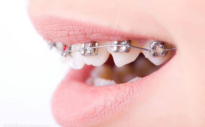 口腔正畸的最佳治療方法？口腔正畸的最佳年齡是多少？