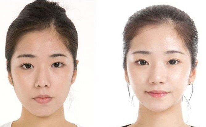 面部吸脂瘦臉的副作用？