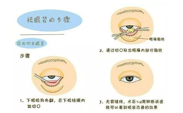 內(nèi)切去眼袋安全性怎么樣?內(nèi)切去眼袋會復(fù)發(fā)嗎?