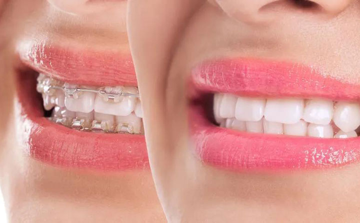 齙牙矯正大概需要花費多少錢？齙牙矯正可以改善凸嘴嗎？