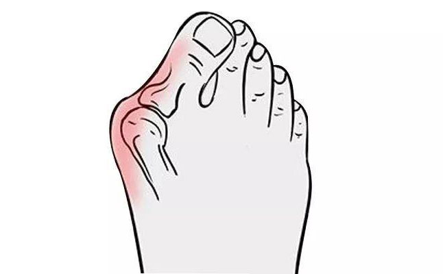 大腳骨矯正手術(shù)多少錢？大腳骨矯正三個(gè)月可以恢復(fù)嗎？