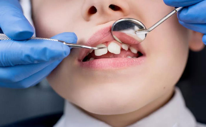 小孩牙齒矯正最佳年齡？小孩牙齒矯正價格多少錢？