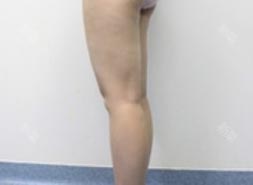 太原時光整形王國軍大腿吸脂案例